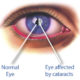Как сохранить зрение при катаракте