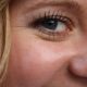 Как справиться с «гусиными лапками» вокруг глаз